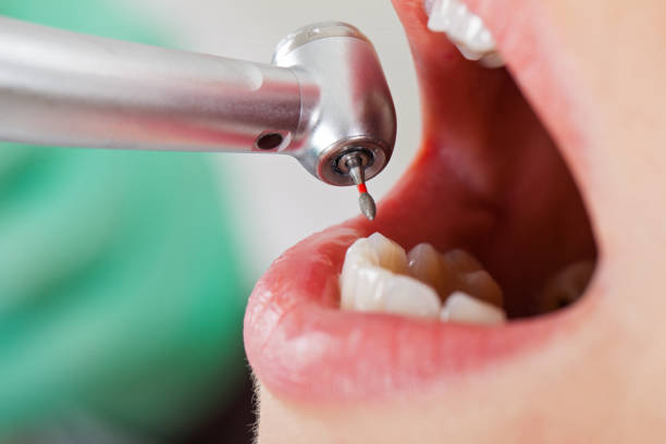 Best Emergency Dental Care for Broken or Chipped Teeth in Berne, IN